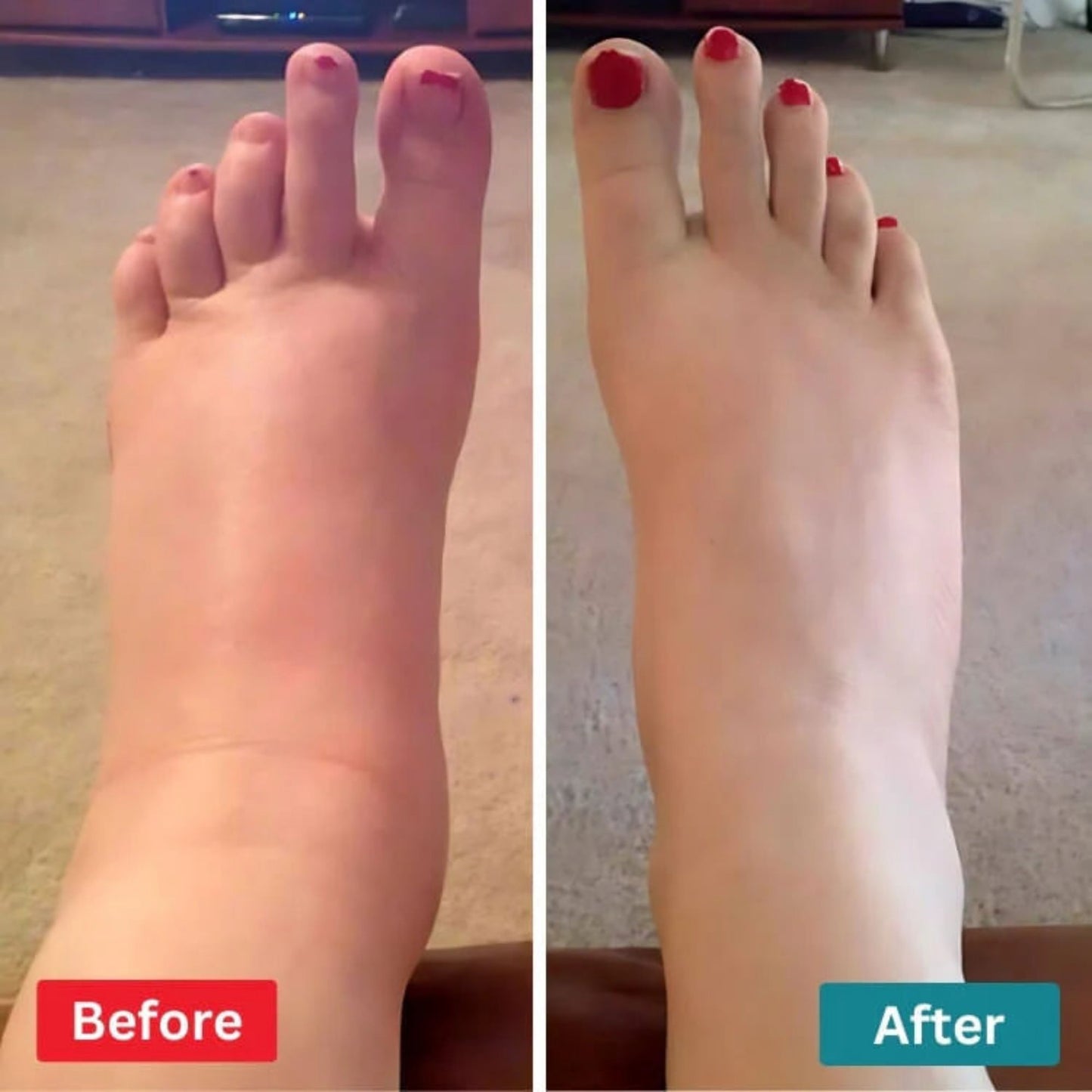 Silkaye™ EMS — Therapy for Foot Drop